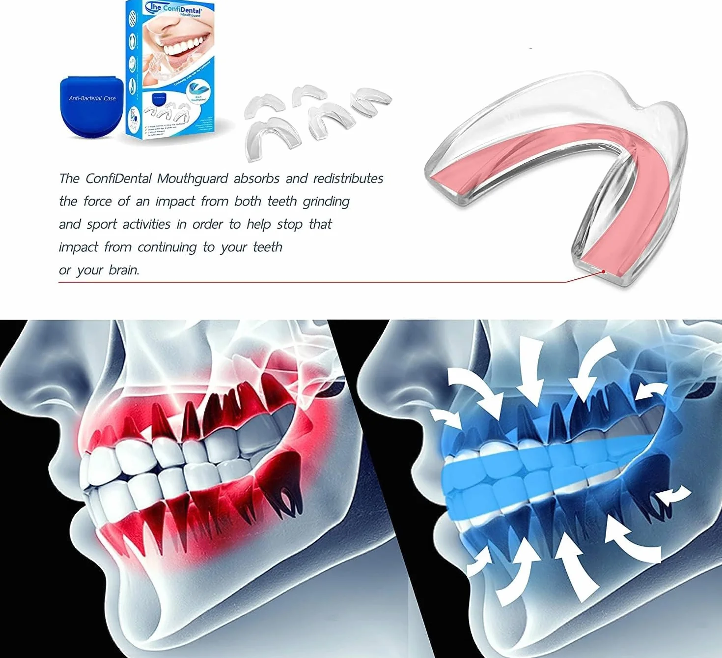 Protectores de boca moldeables para bruxismo, paquete de 5, 3 regulares y 2 resistentes