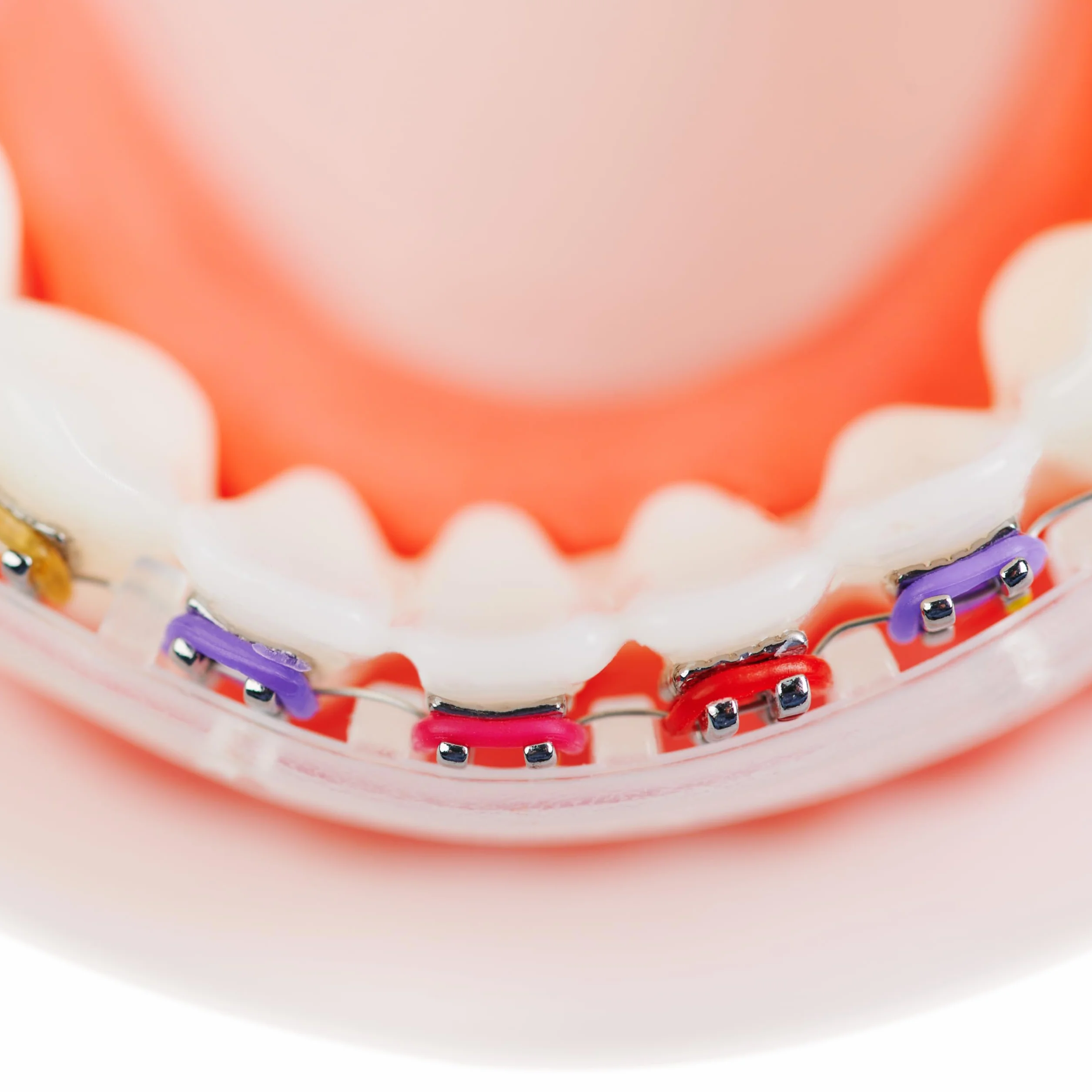 Protector de labios para brackets, funda ortodóntica cómoda alternativa a la cera